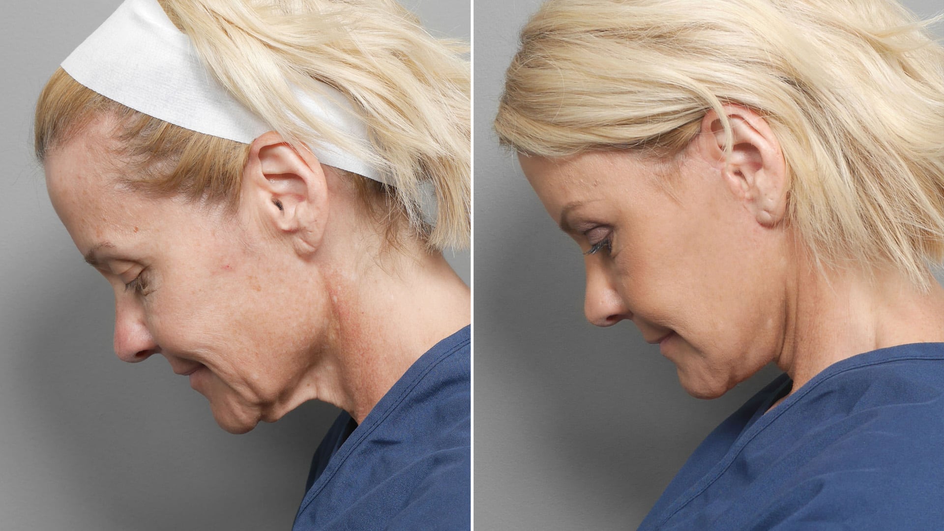 Deep plane face lift before and after. side view.