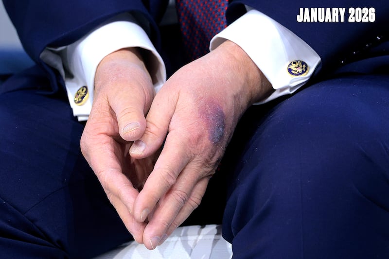 A bruise appears on the back of U.S. President Donald Trump's left hand during a signing ceremony for the “Board of Peace” at the World Economic Forum (WEF) on January 22 in Davos, Switzerland.