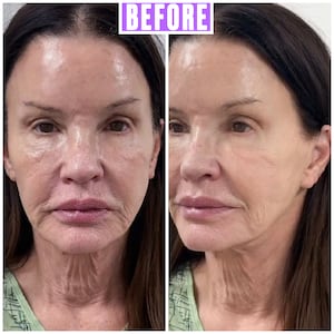 Janice Dickinson Debuts Incredible Facelift Results at 71