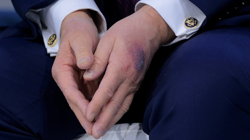DAVOS, SWITZERLAND - JANUARY 22: A bruise appears on the back of U.S. President Donald Trump's left hand during a signing ceremony for the “Board of Peace” at the World Economic Forum (WEF) on January 22, 2026 in Davos, Switzerland. The US-backed “Board of Peace” is intended to administer the fragile ceasefire in the Gaza Strip after the war between Israel and Hamas. The final makeup of the board has not been confirmed. (Photo by Chip Somodevilla/Getty Images)