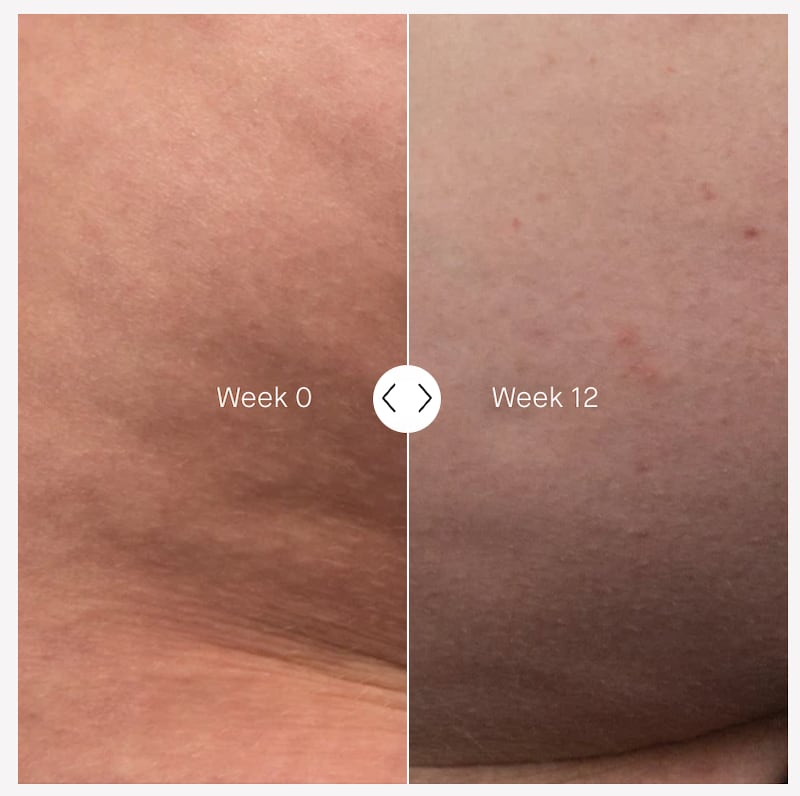 Augustinus Bader the Body Cream Cellulite Before and After