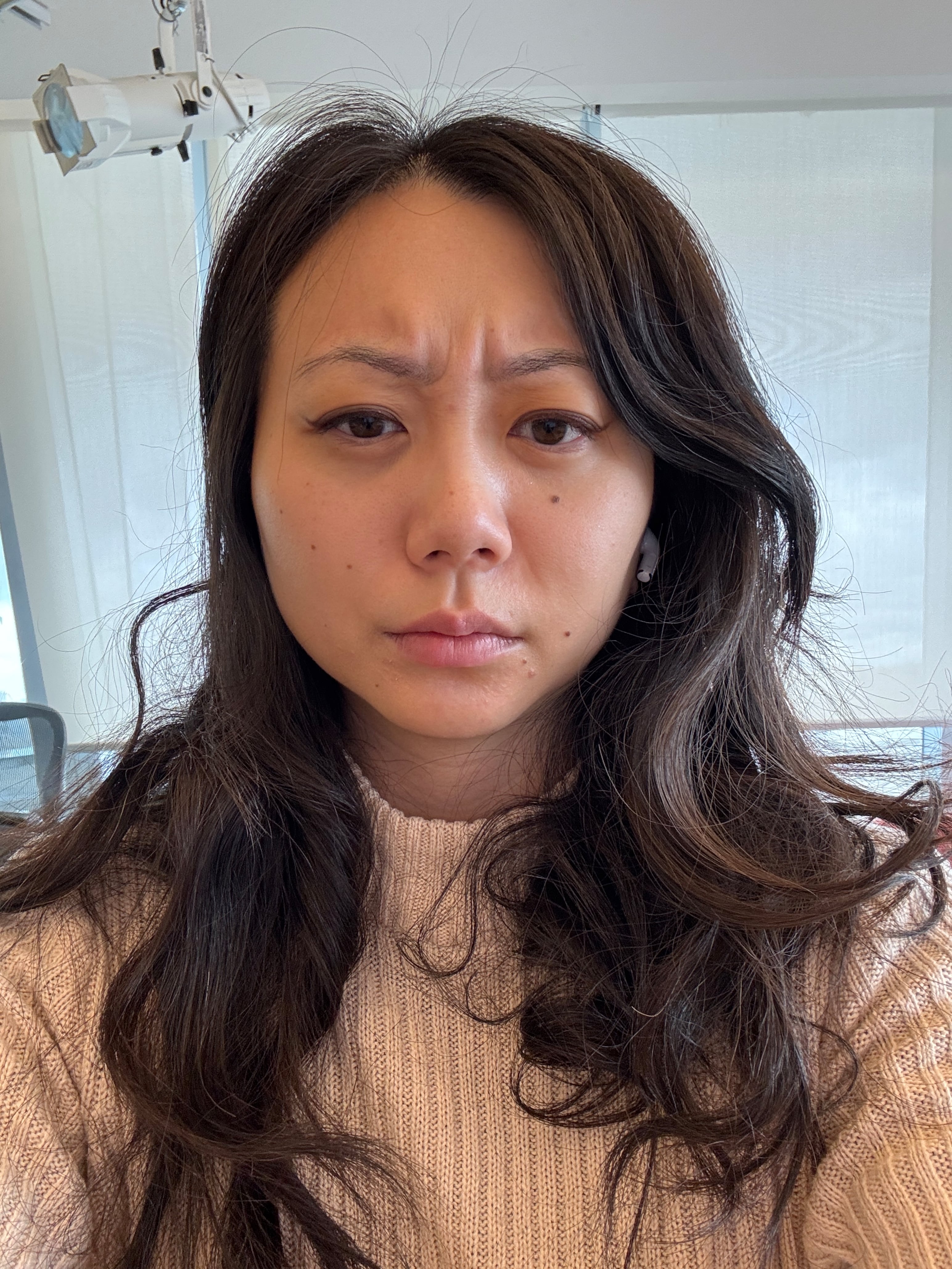 Frowning with baby botox.