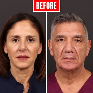 Before and after photos showing a couple who got face lifts