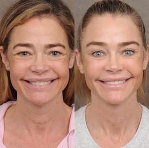 Denise Richards facelift
