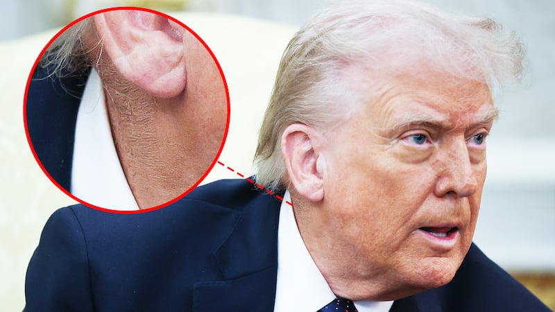 A circle highlighting makeup covering a rash on Trump's neck. President Donald Trump answers questions while meeting with German Chancellor Friedrich Merz in the Oval Office of the White House March 3, 2026 in Washington, DC.
