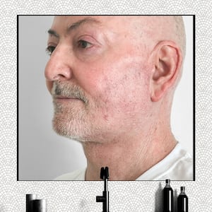 David's jawline transformation. 3/4 view