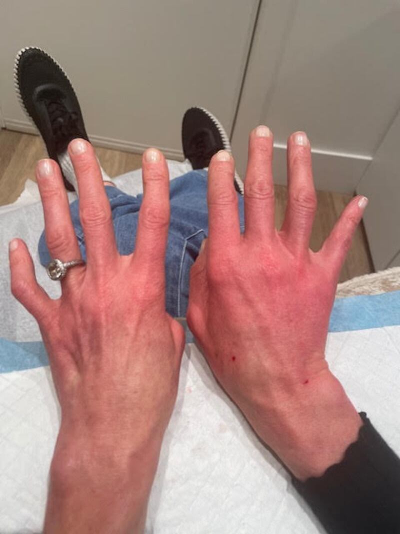 Jill's hands during the procedure.