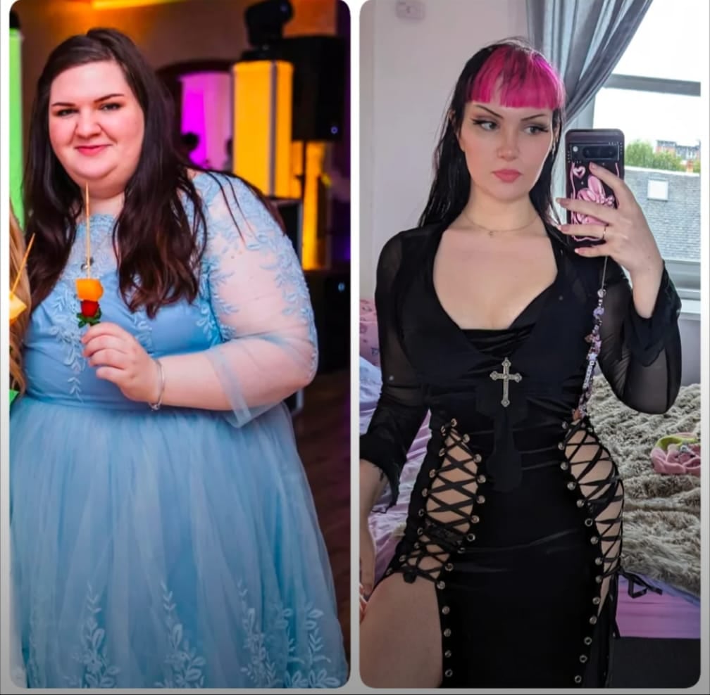 A before-and-after of the subject. Winter had a total of ten cosmetic surgeries to fix her body dysmorphia.