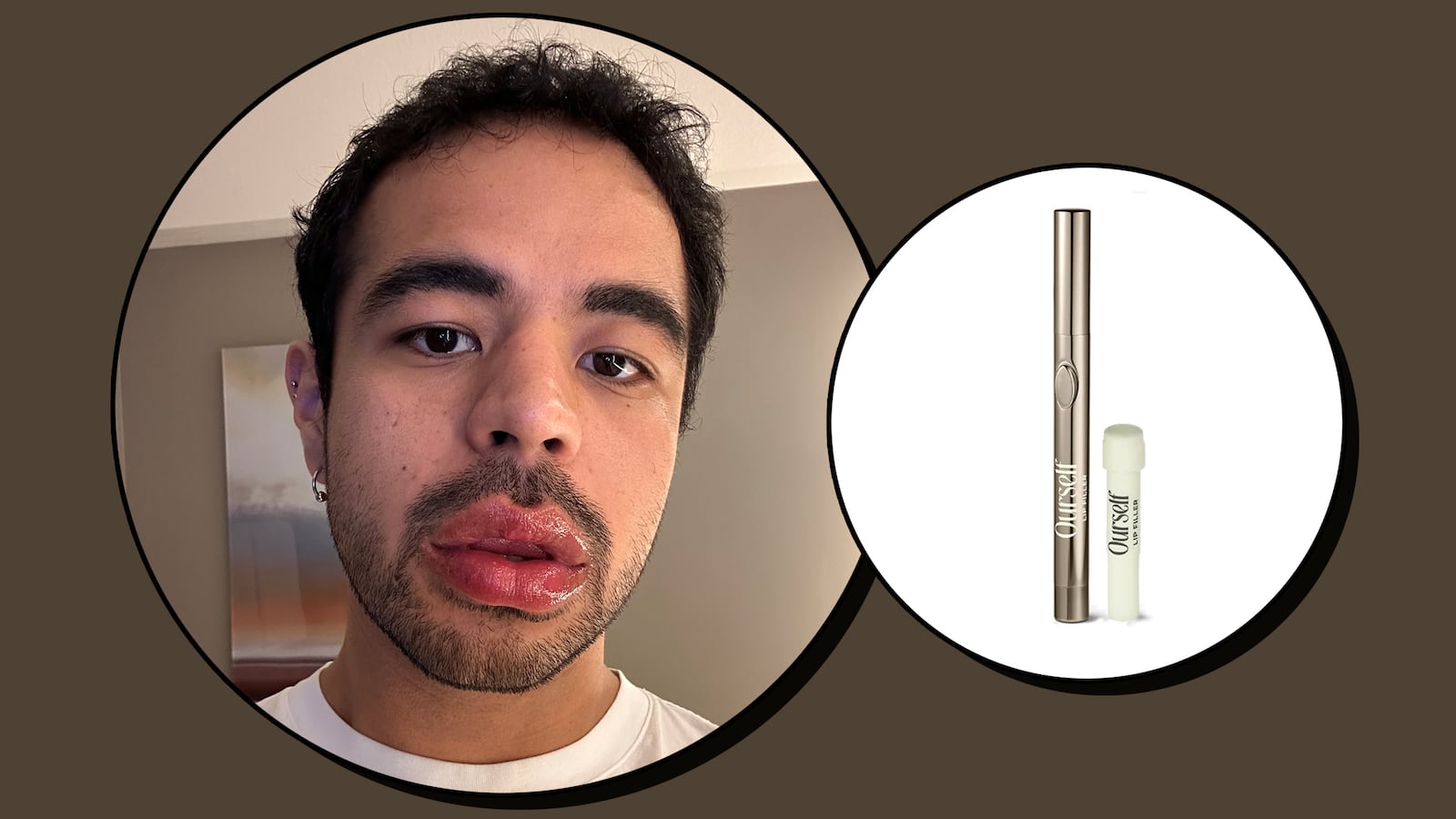 Ourself Lip Filler Before and After Review