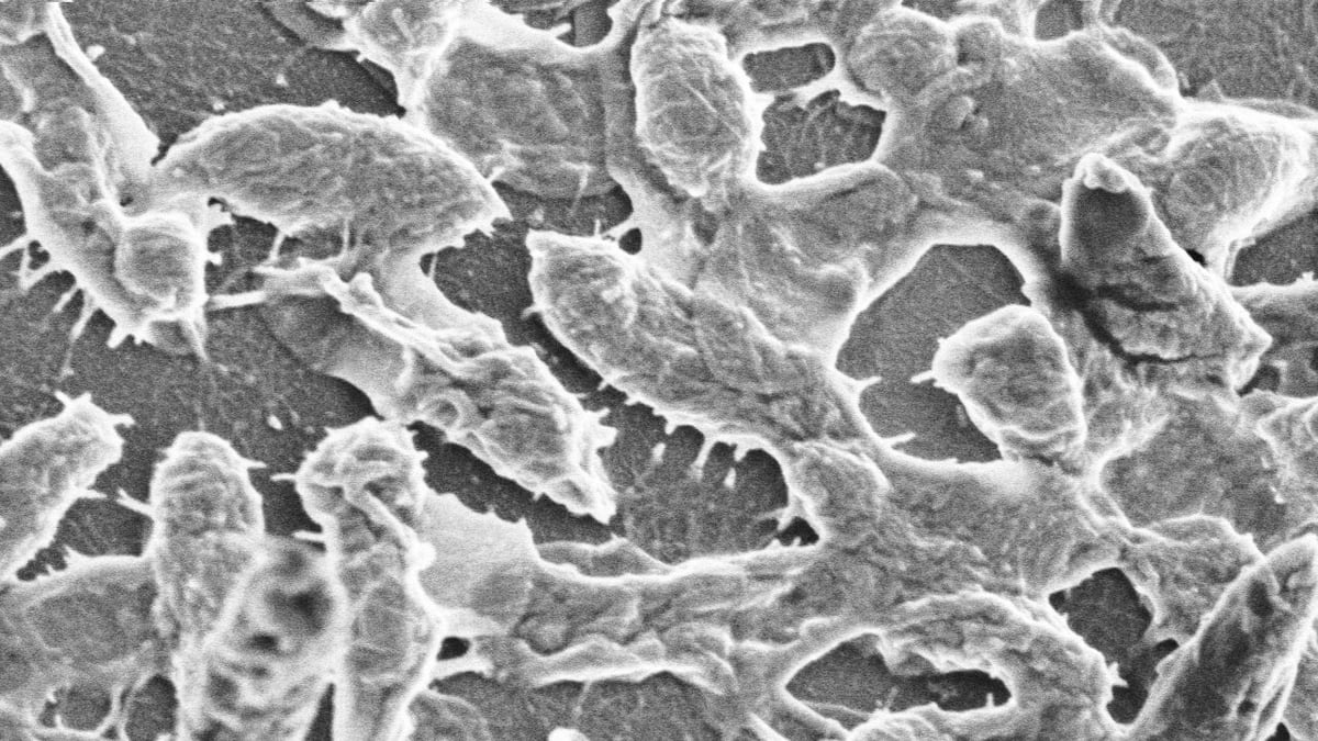 articles/2012/05/18/necrotizing-fasciitis-blinding-larvae-more-scary-diseases/flesh-eating-bacteria-schwartz_dwcdzx