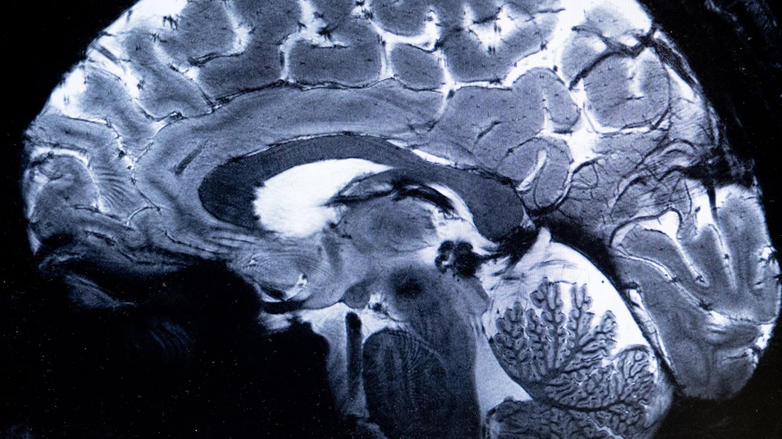 An MRI done in 2024 shows a brain during a magnetic resonance imaging (MRI) exam simulation at the Neurospin facilities in the Paris-Saclay Alternative Energies and Atomic Energy Commission.