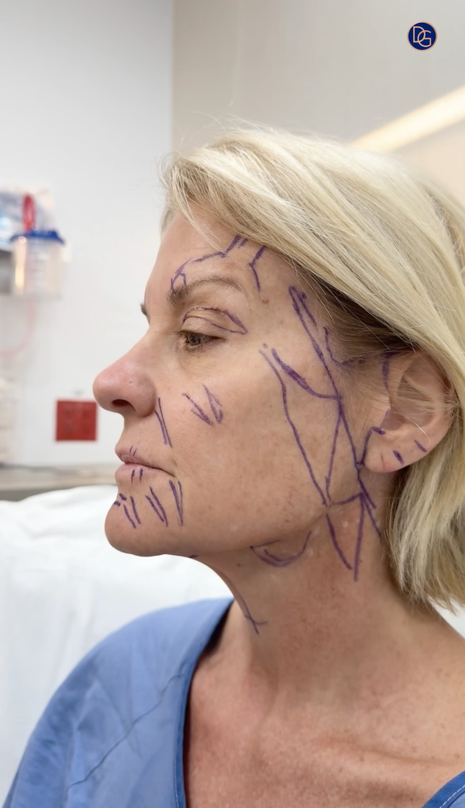 Regina's pre-surgery mark-up.