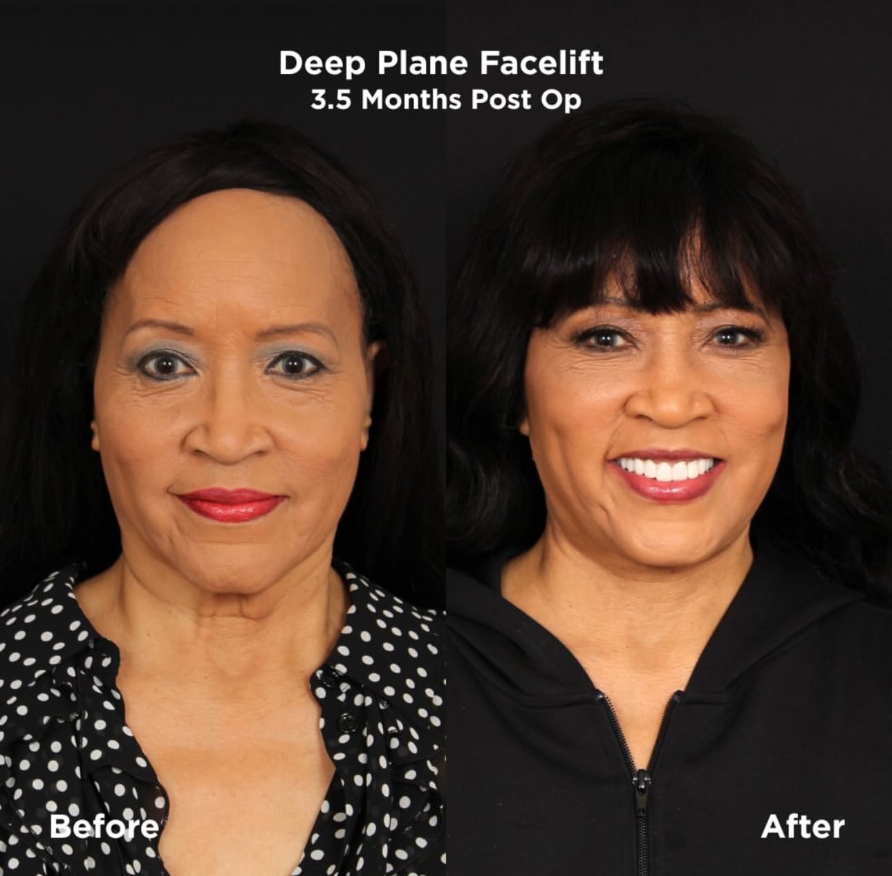 Jackée Harry's deep-plane facelift.