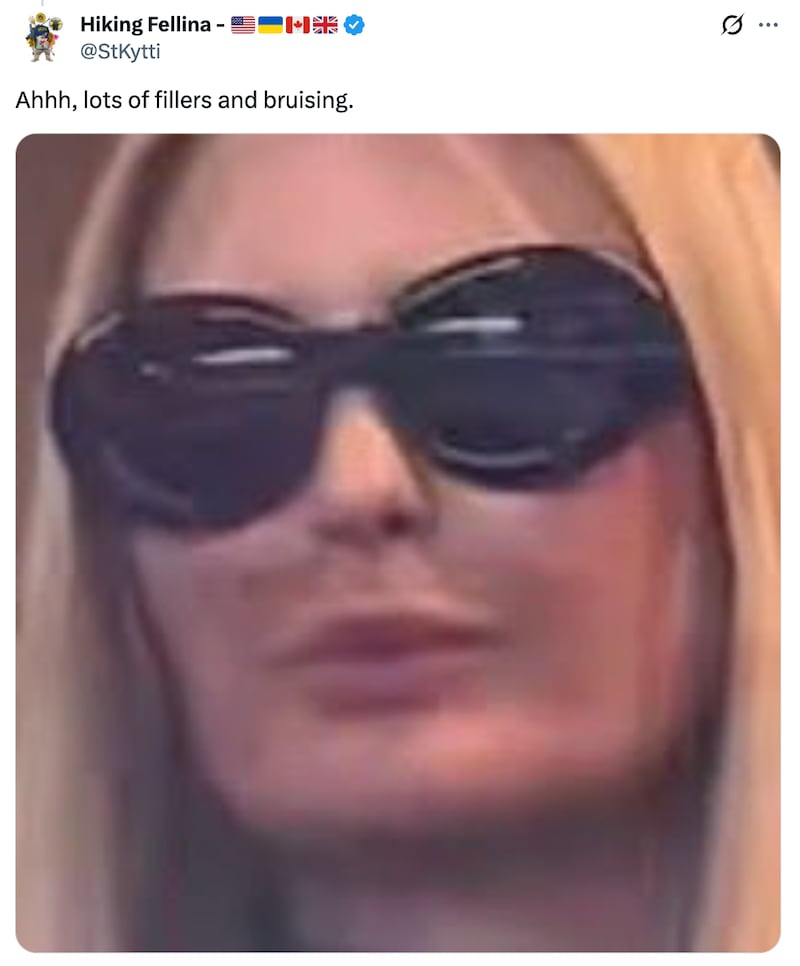 X user sees lip fillers and bruising in pictures of Ivanka