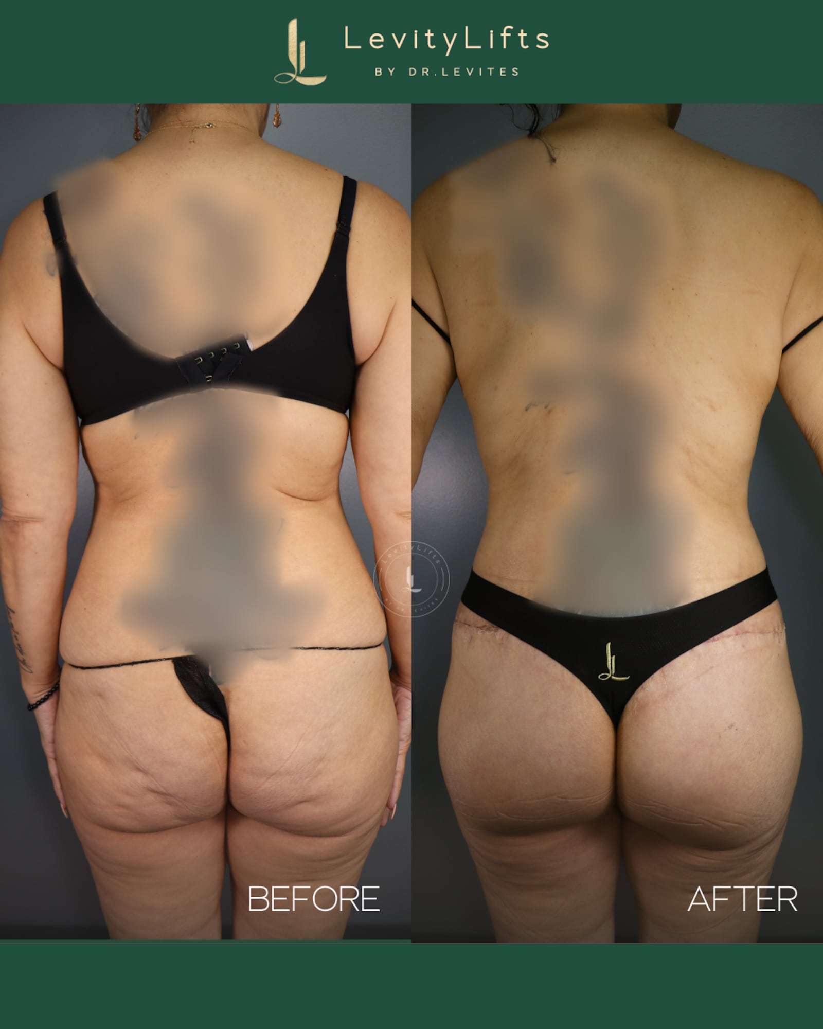 Dr. Levits Ozempic patient's body before and after.