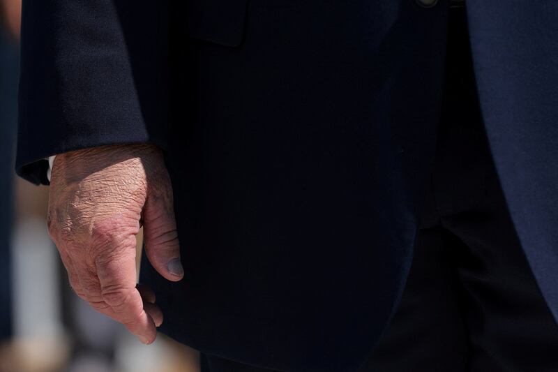 Make-up covers the back of Trump's hand as he speaks to reporters about the helipad being constructed on the South Lawn at the White House.