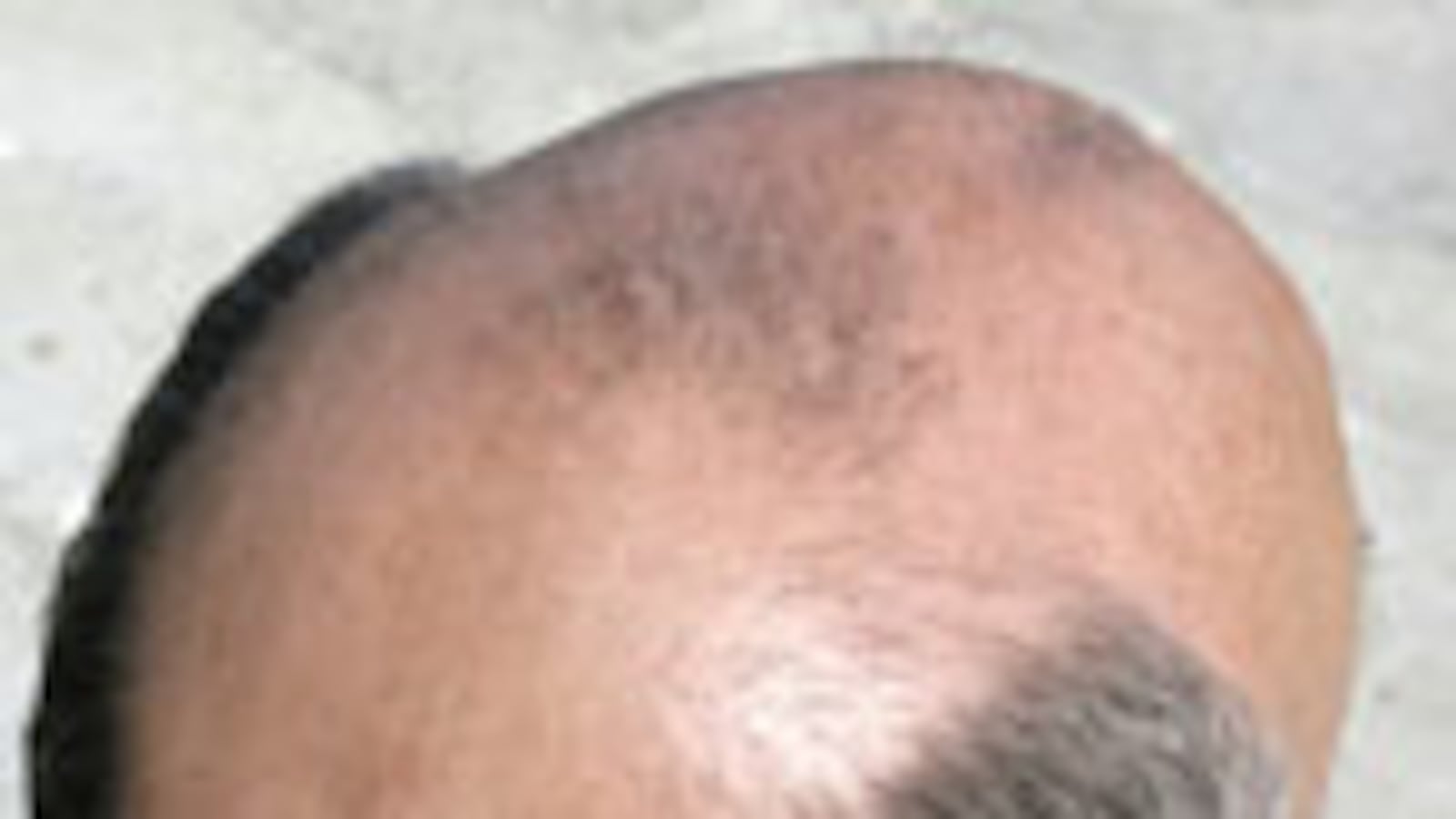 cheats/2008/10/14/why-am-i-going-bald/bald_fik8lm