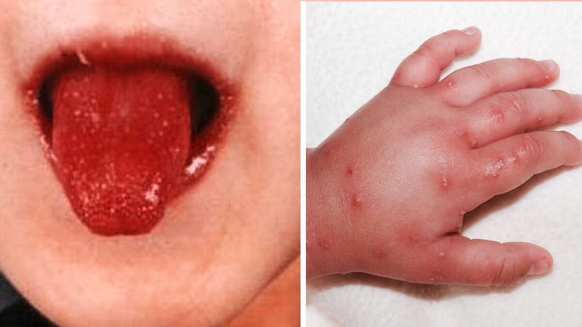 200511-rawnsley-disease-tease_kf19jg