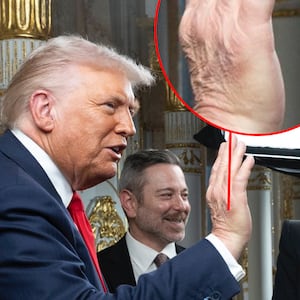 Donald Trump greets CBS executives with a bruised hand.