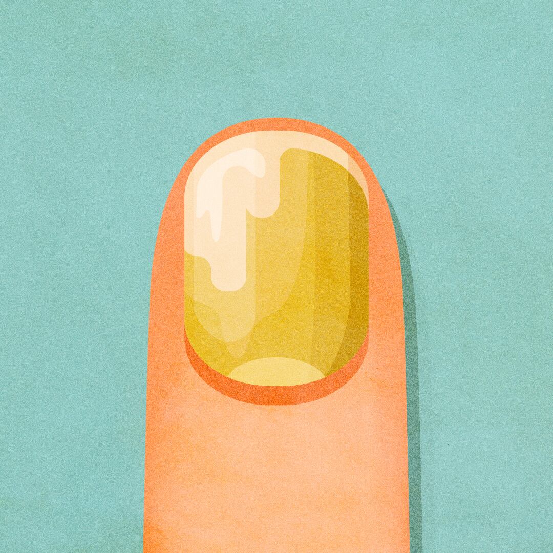 Thick, discolored nails