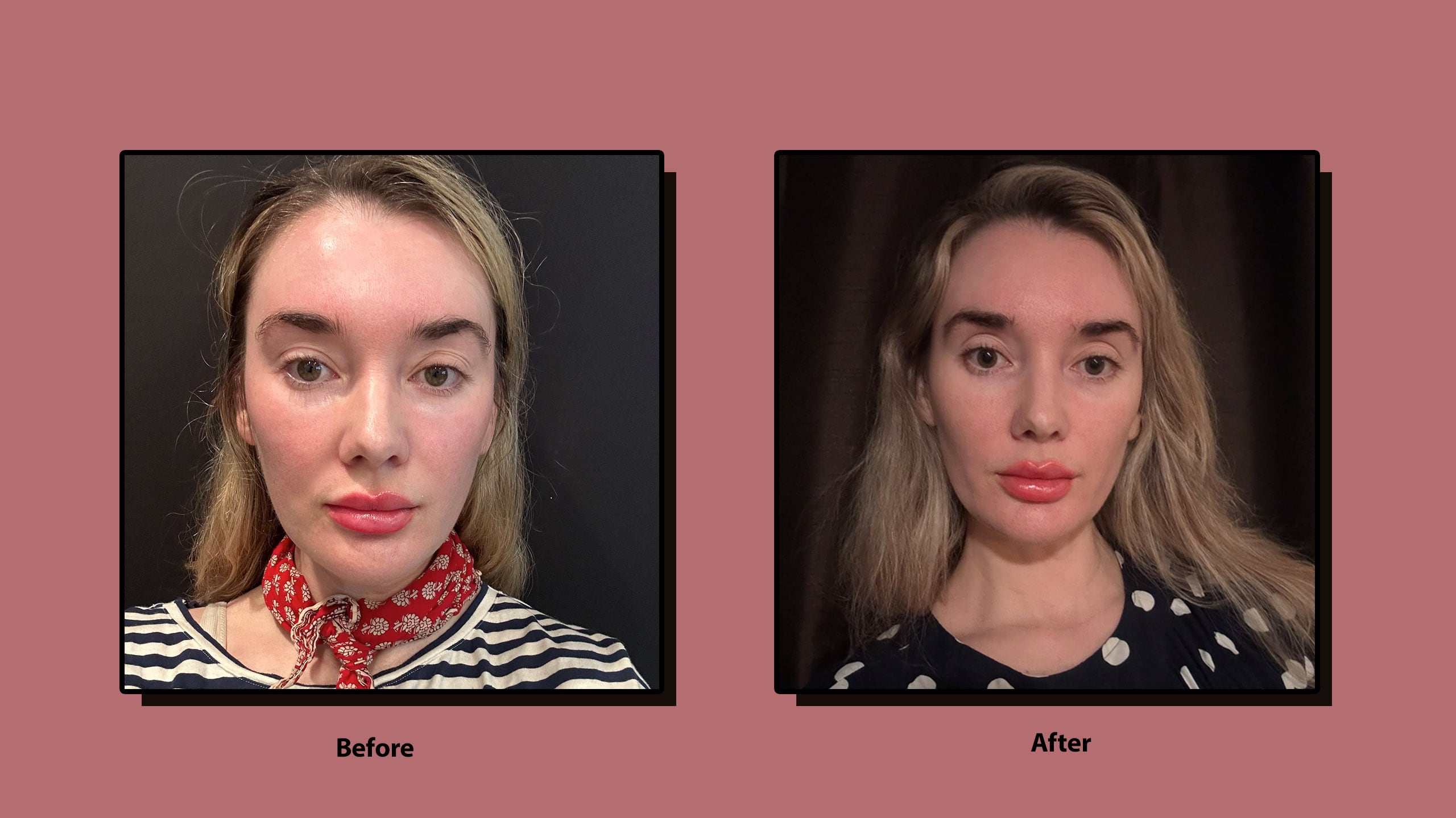 sofwave jawline sagging glp-1 weight loss effectiveness Sofawave Before and After Review