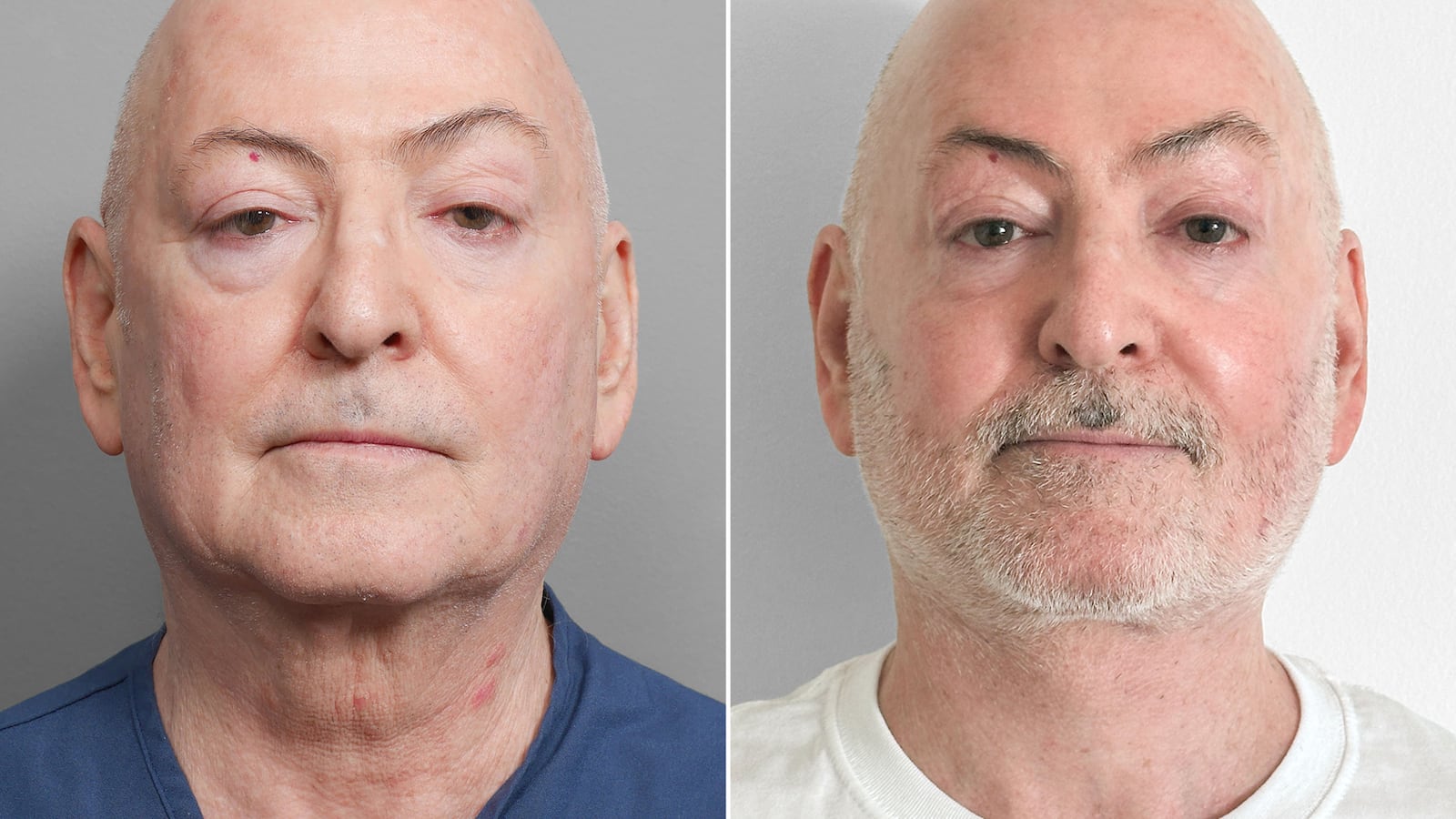 David's jawline before and after. Front view