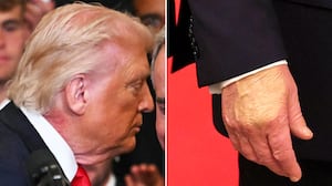 President Donald Trump's neck rash and hand makeup during the MLS Cup Champions Inter Miami CF event in the East Room of the White House on March 5, 2026 in Washington, DC.