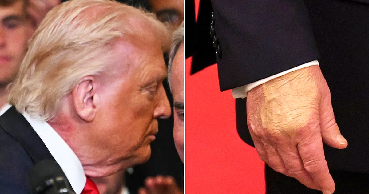 Trump, 79, schminkt sich die verletzte Hand, kann aber den Ausschlag am ...