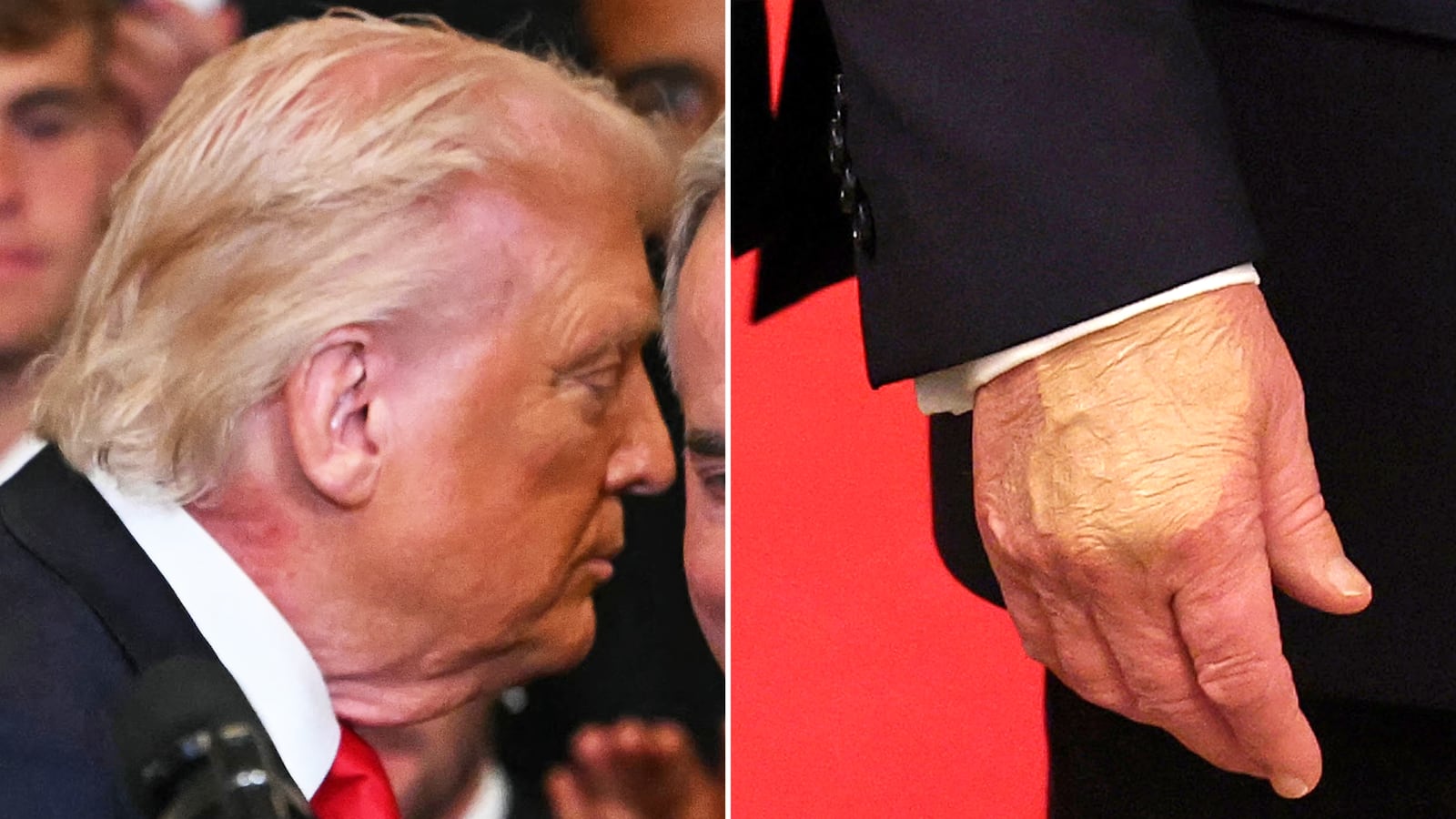 President Donald Trump's neck rash and hand makeup during the MLS Cup Champions Inter Miami CF event in the East Room of the White House on March 5, 2026 in Washington, DC.