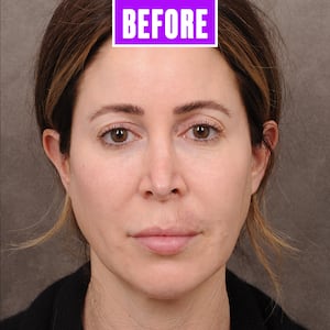 Britney Semler before her facelift, February 26, 2021.