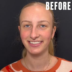 "Before" photo of Dr. Kassir's rhinoplasty patient, Jacqueline.
