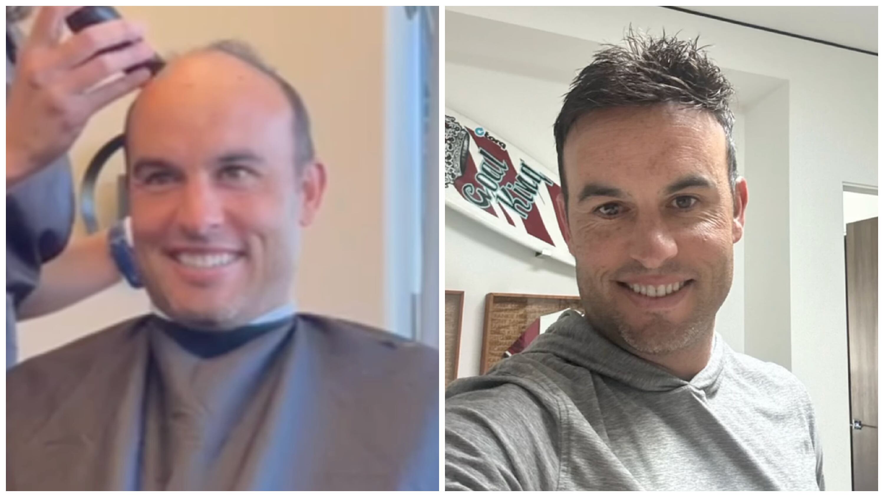 On left, Landon Donovan gets the top of his head shaved during his hairpiece installation; on right, Donovan shows off the results.