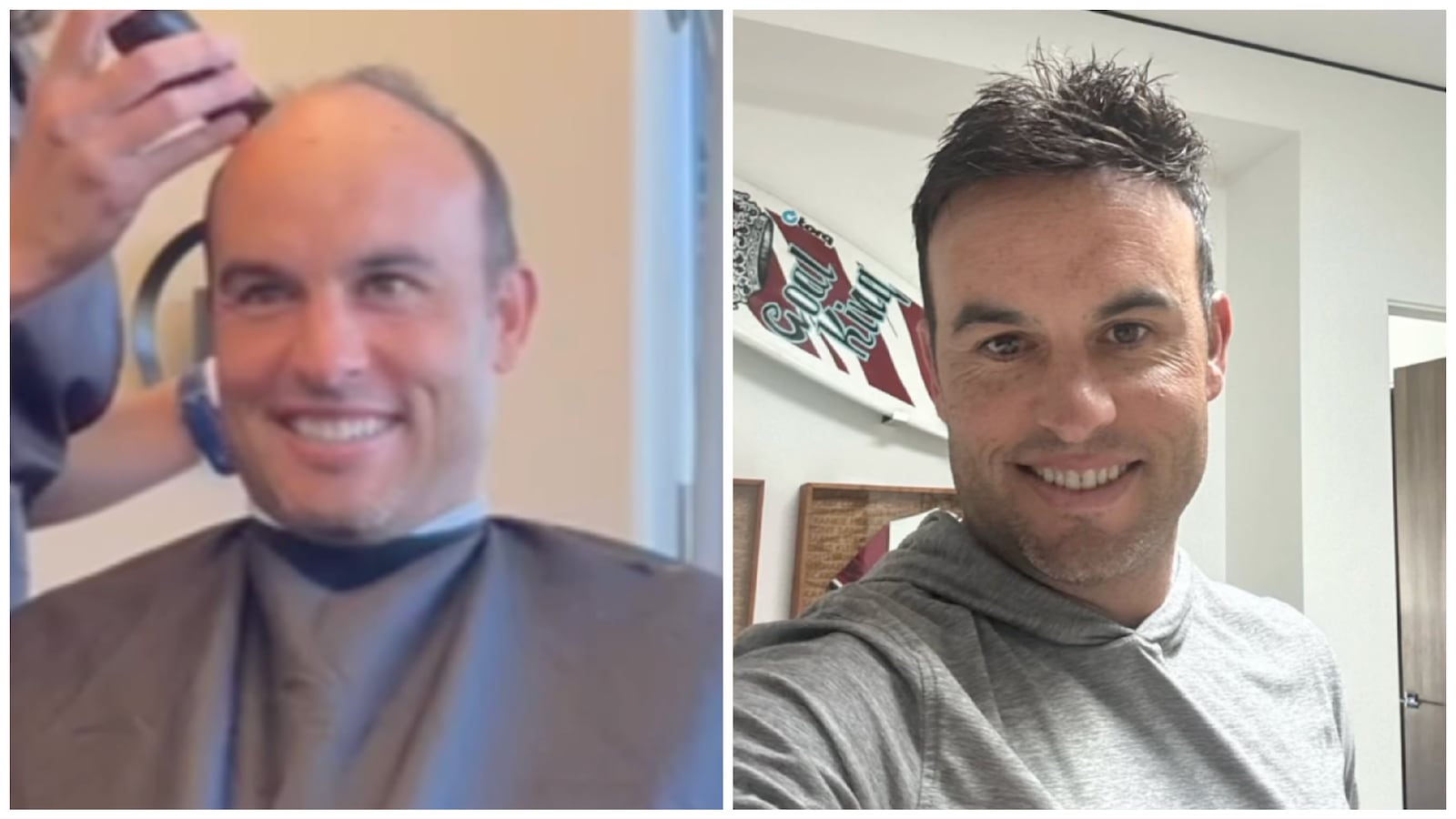 On left, Landon Donovan gets the top of his head shaved during his hairpiece installation; on right, Donovan shows off the results.