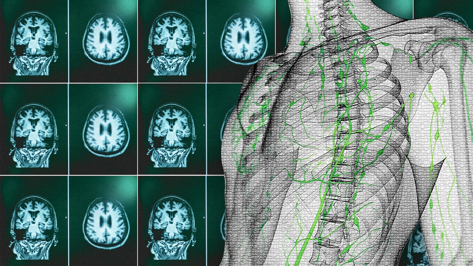 skeleton alzheimer's alzheimers disease no cure brain beta amyloid rudolph tanzi robert moir harvard