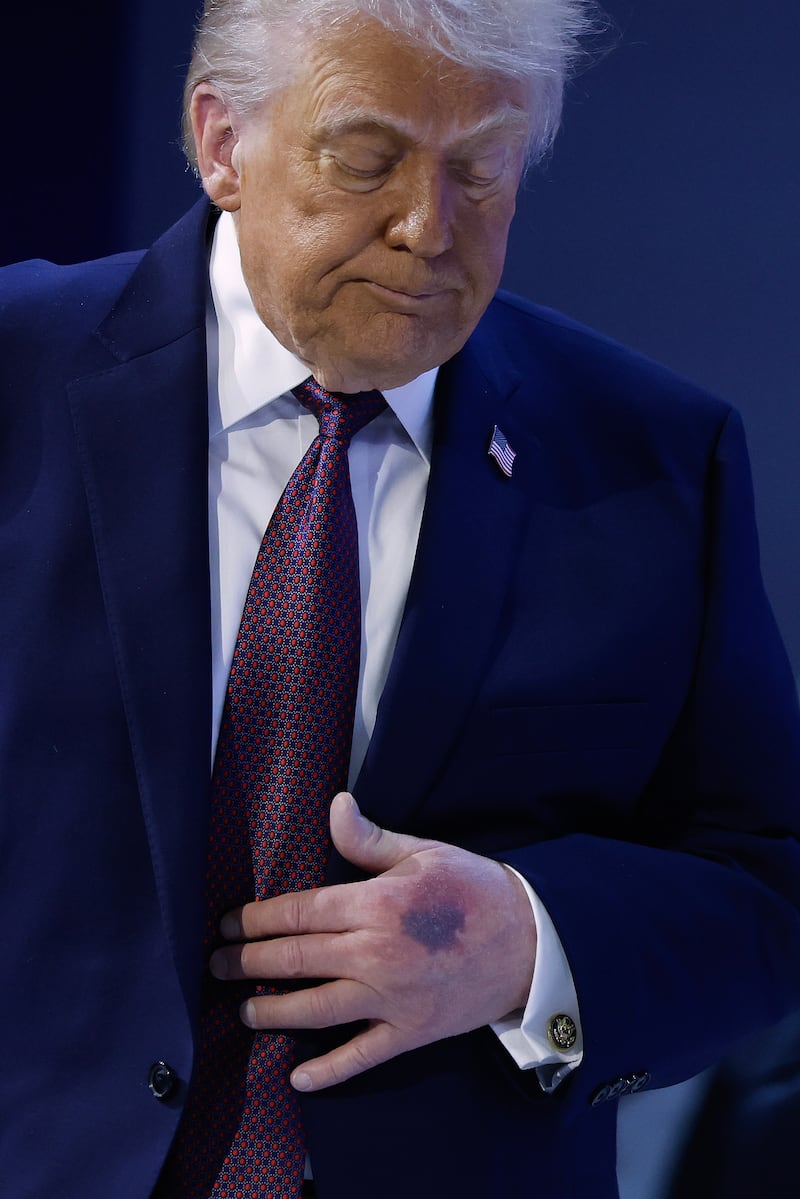 DAVOS, SWITZERLAND - JANUARY 22: A bruise can be seen on the back of U.S. President Donald Trump's left hand during a signing ceremony for the “Board of Peace” at the World Economic Forum (WEF) on January 22, 2026 in Davos, Switzerland. The US-backed “Board of Peace” is intended to administer the fragile ceasefire in the Gaza Strip after the war between Israel and Hamas. The final makeup of the board has not been confirmed.  (Photo by Chip Somodevilla/Getty Images)