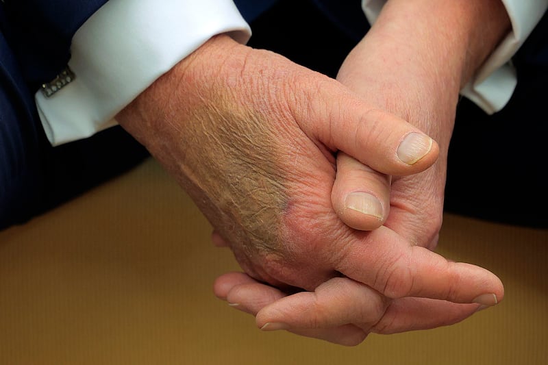 Makeup covers a bruise on the back of U.S. President Donald Trump's hand in February 24, 2025 in Washington, DC.