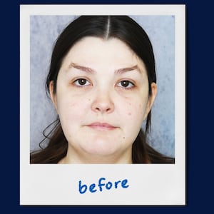 A photo illustration of chin lipo suction before and after for the Looker.