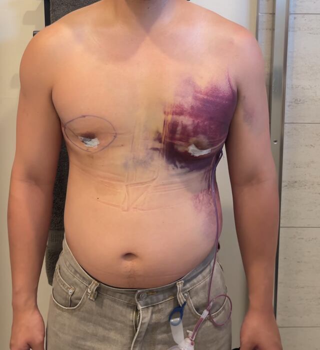 Jon Michael during recovery.