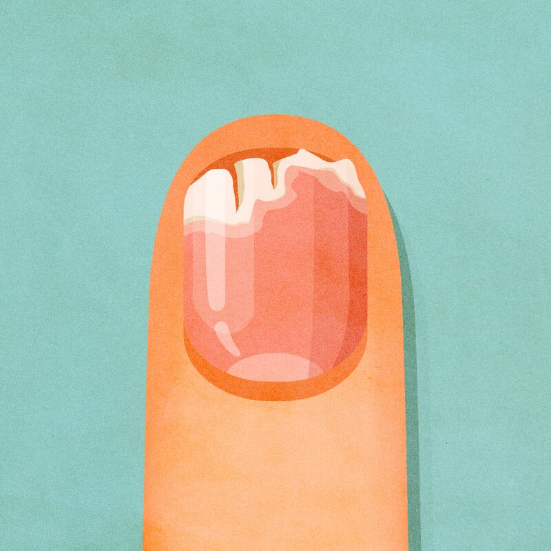 Brittle nail