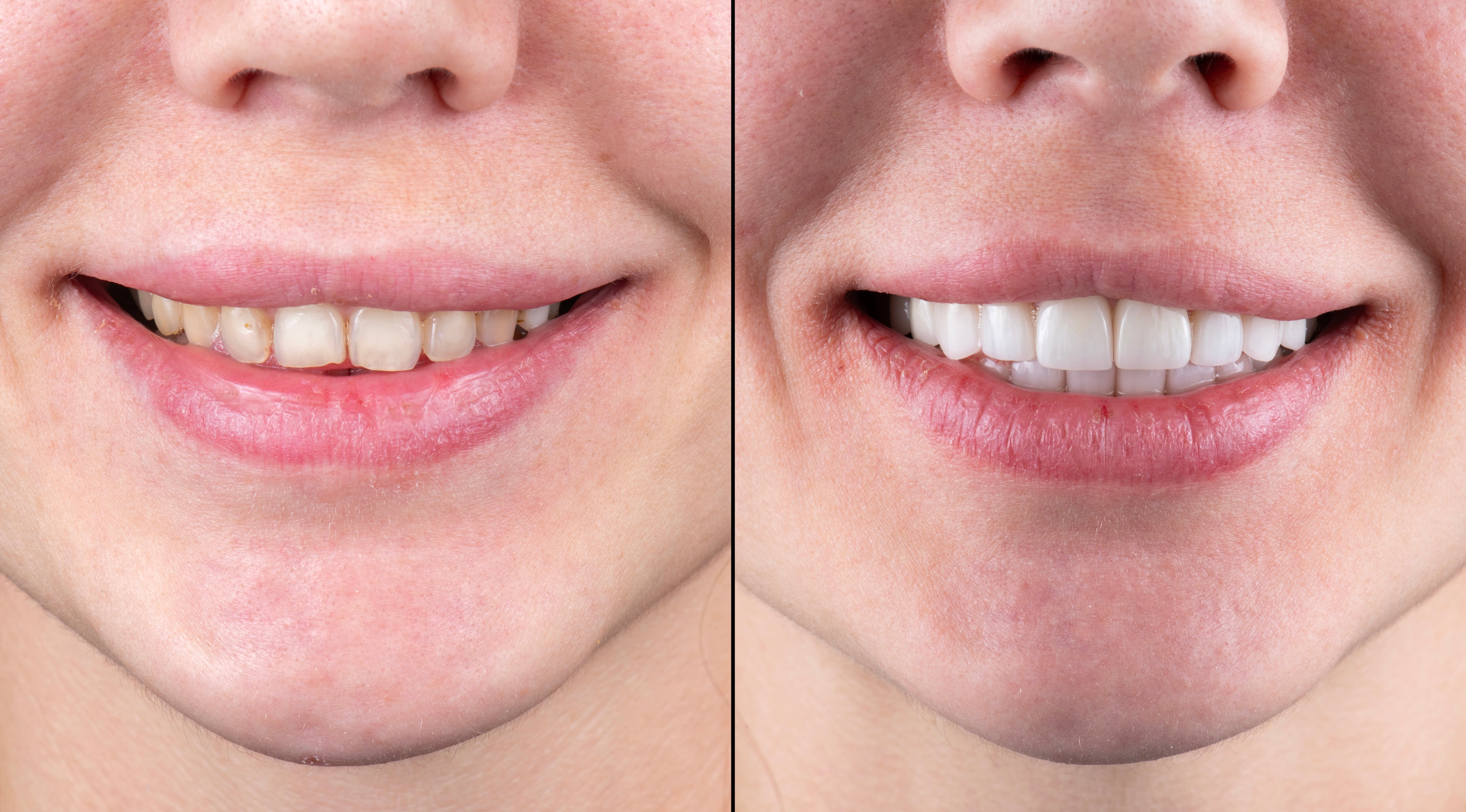 Ceramic veneer makeovers, like the one shown, have surged in the last 10 years, with more people than ever seeking the cosmetic procedure.