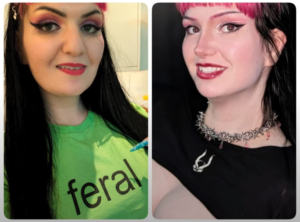 A before-and-after of the subject. Winter had a total of ten cosmetic surgeries to fix her body dysmorphia.