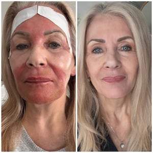 Pamela Allyn croton oil peel