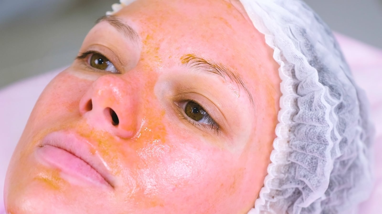 Chemical peeling of the woman's face. Cleaning the face skin and lightening freckles skin.