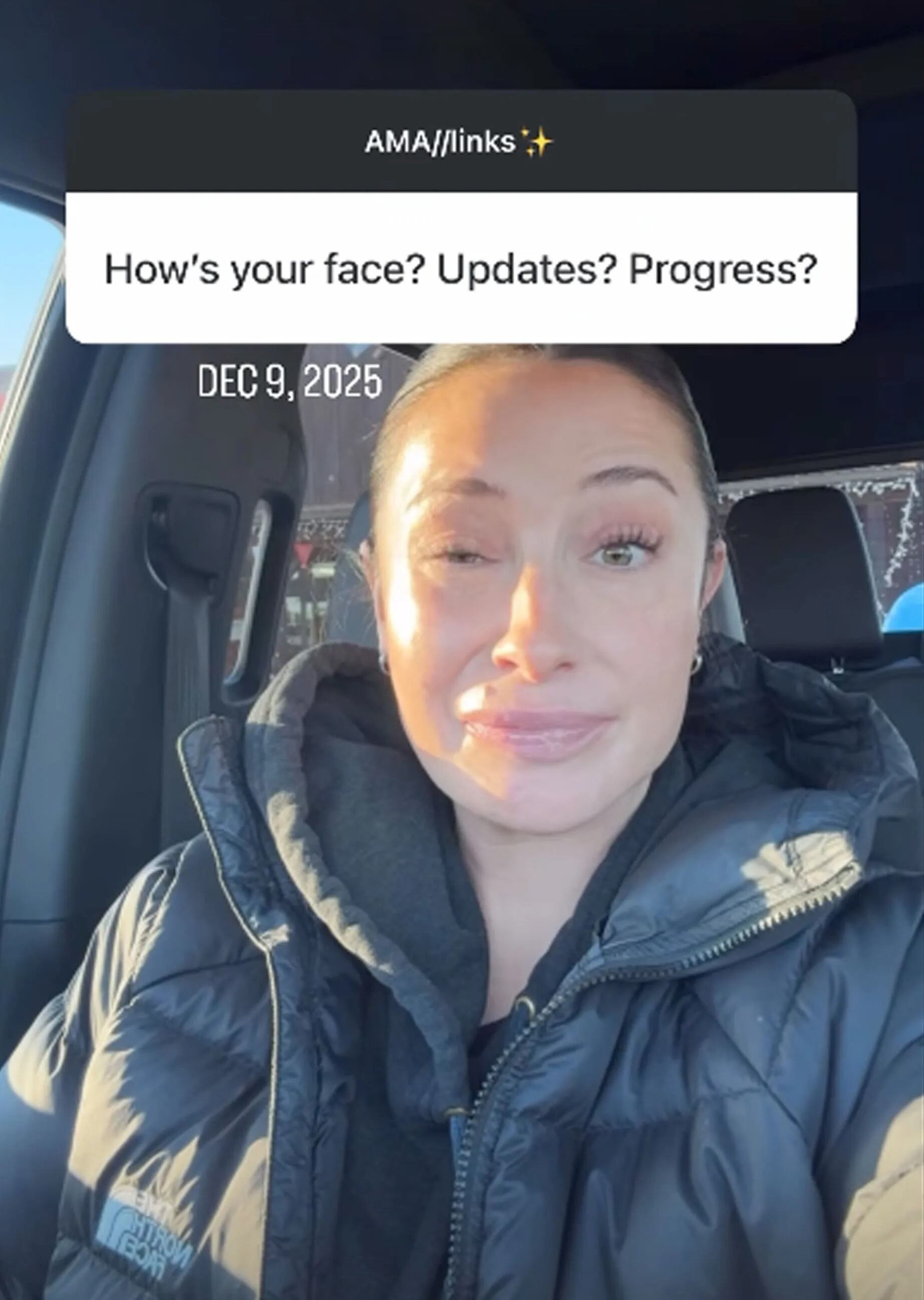 Bristol Palin responds to a fan's question about the status of her facial paralysis during an "Ask Me Anything" on Instagram.