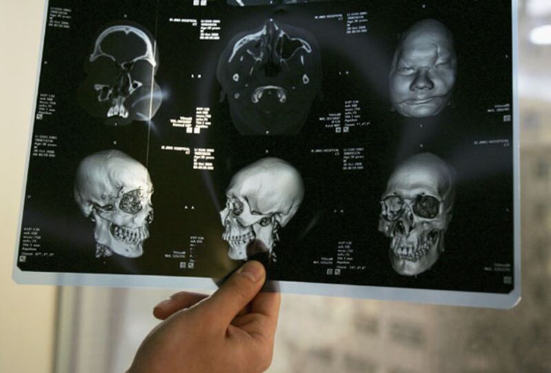 galleries/2009/11/24/our-list-most-startling-medical-discoveries-of-the-last-10-years/last-decade-med-innovations---face-transplant_payfig