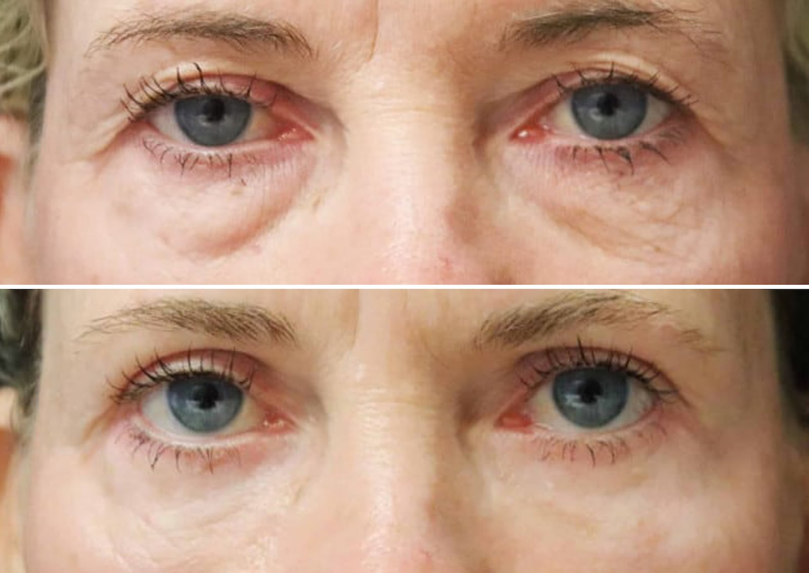 Lower blepharoplasty eyelid surgeries before and after.