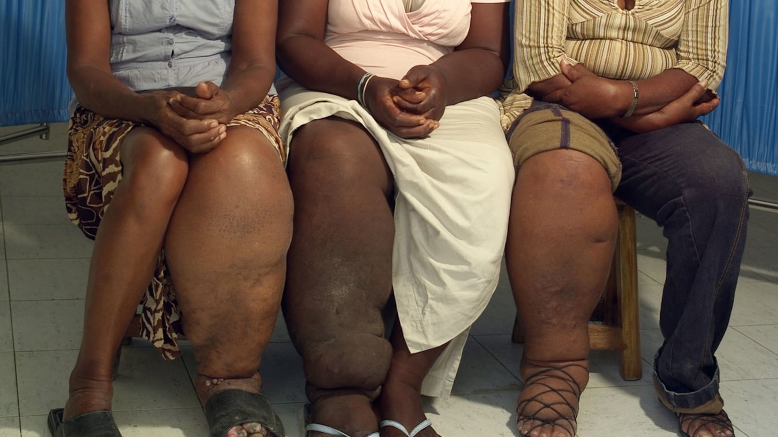 cheats/2012/10/01/haiti-battles-elephantiasis/elephantiasis-haiti-cheat_goo5uv