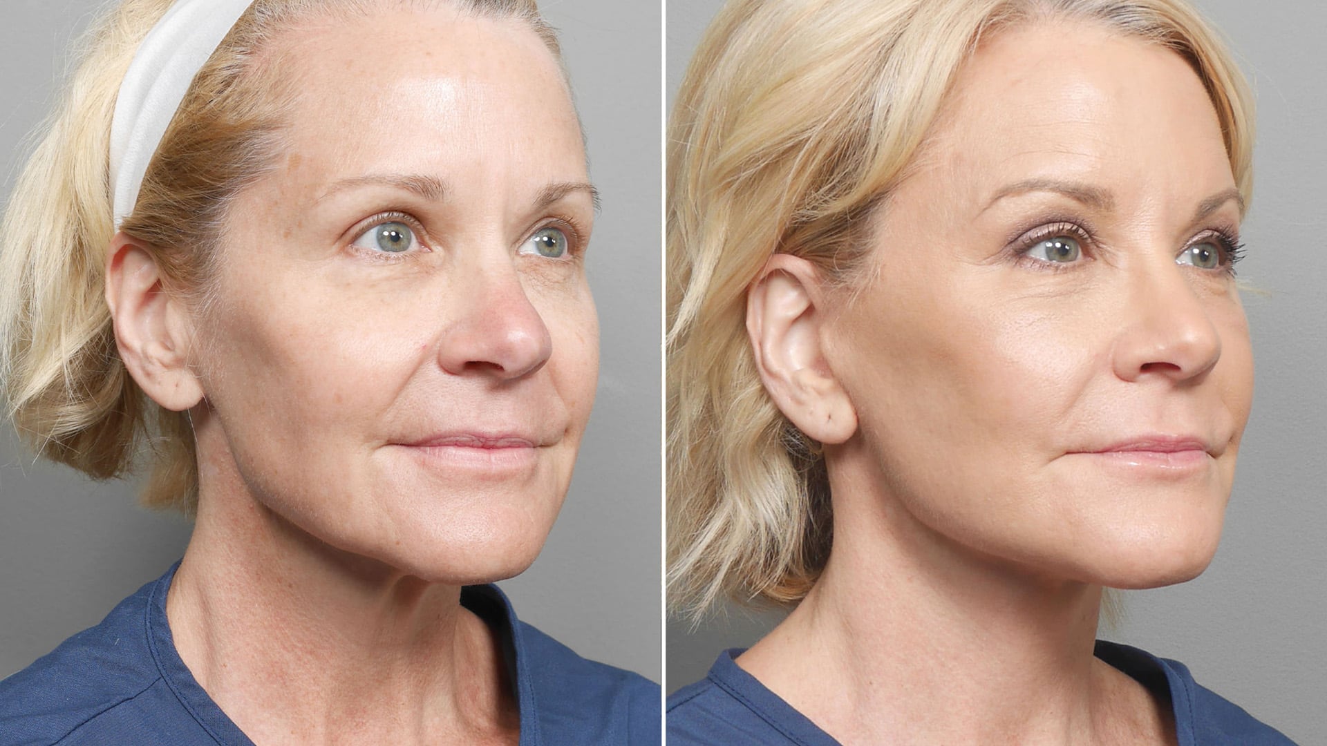 Deep plane face lift before and after. 3/4 view.