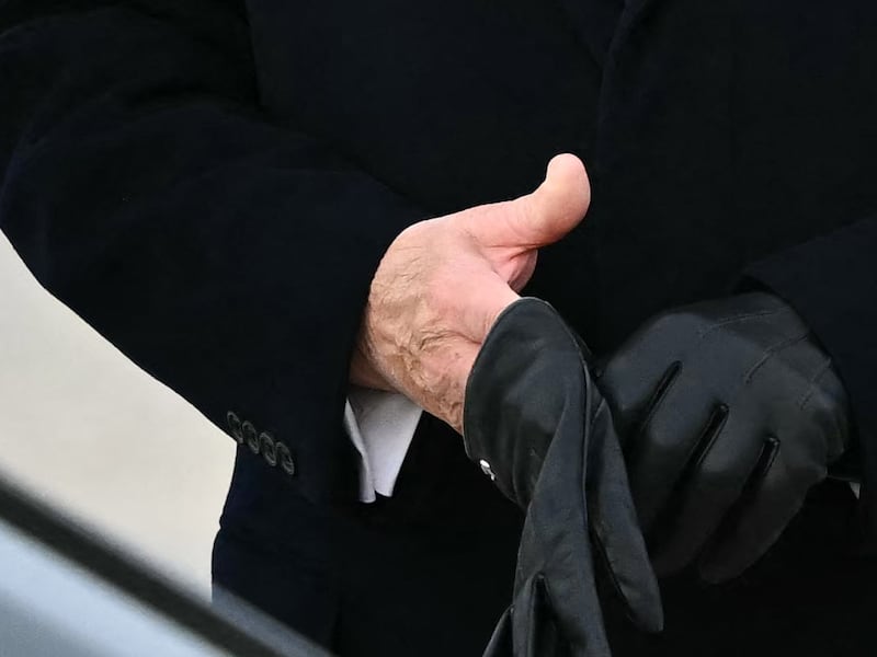 Trump's hand bruising, the White House says, is caused by frequent handshaking and his Aspirin usage.