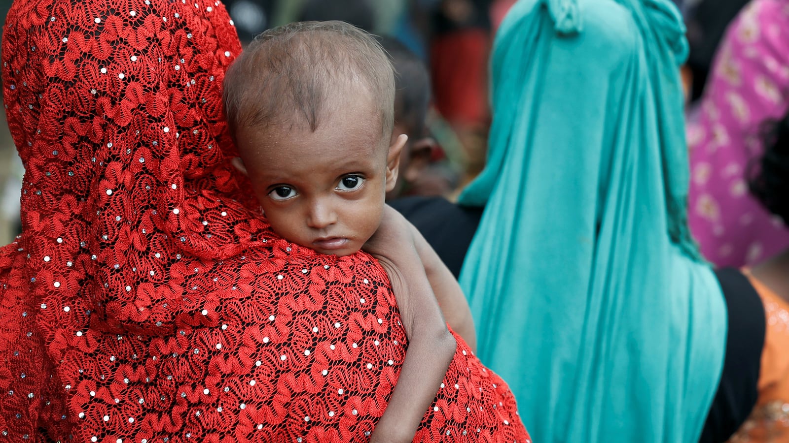 A malnourished Rohingya refugee in Cox's Bazar, Bangladesh